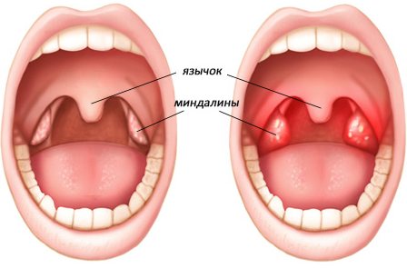 Воспаление гланд: симптомы, лечение, диагностика и профилактика. лечение народными средствами