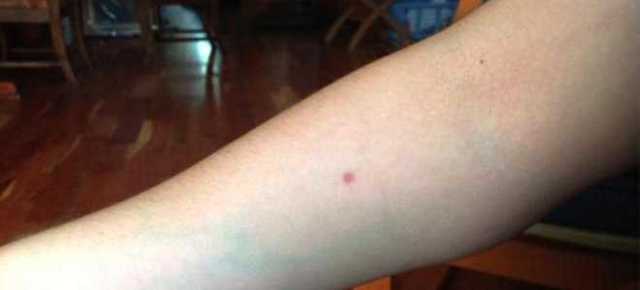 Прививка дст – что это такое? диаскинтест и манту – в чем разница