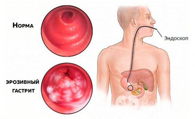 Дуоденогастральный рефлюкс: симптомы дгр, лечение