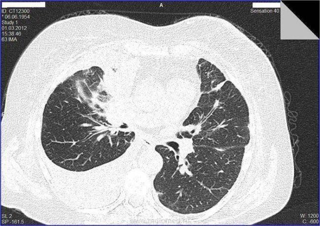 Очаги на кт легких