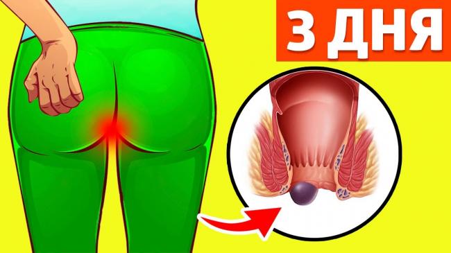 Наружный геморрой: симптомы, причины и лечение