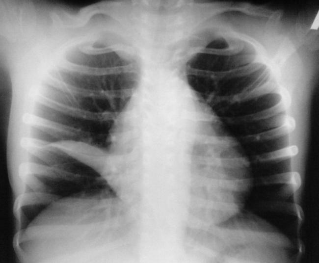 Ателектаз легких: причины, симптомы, лечение