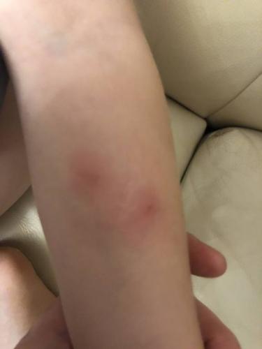 Температура после манту у детей и взрослых: причины, как избежать?