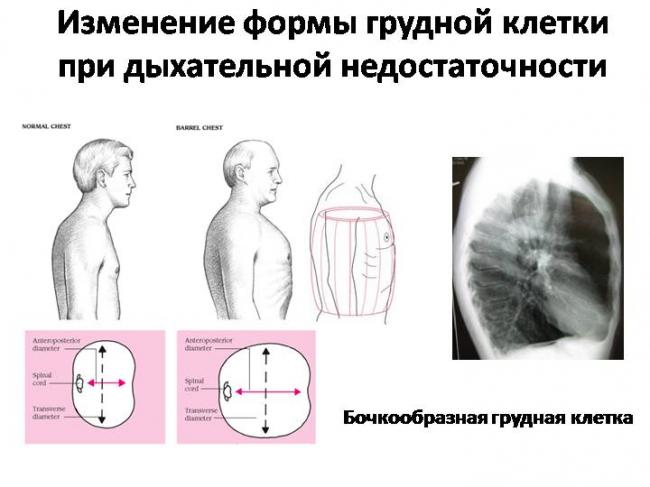 Деформация грудной клетки: причины заболевания, основные симптомы, лечение и профилактика