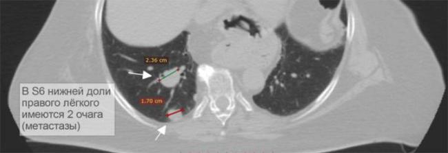 Когда назначают томографию легких