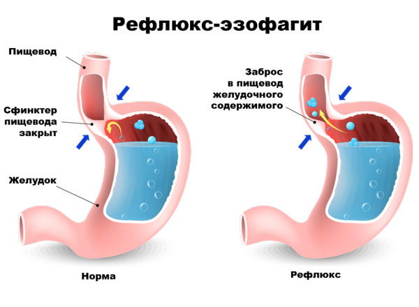 Питание при рефлюкс-эзофагите: меню на каждый день