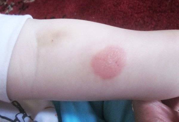 Аллергия на реакцию манту
