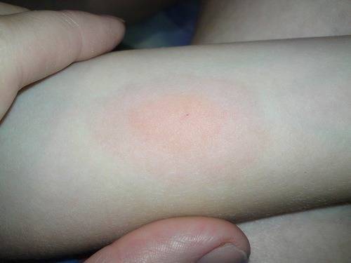 Аллергия на реакцию манту