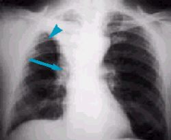 Ателектаз — что это такое? виды, симптомы и лечение, прогноз