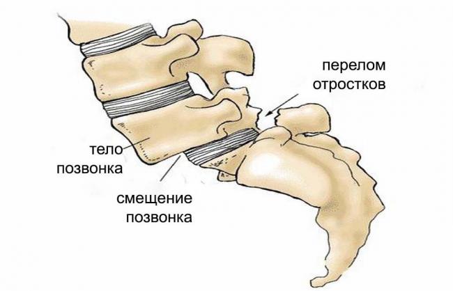 Смещение позвонков поясничного отдела