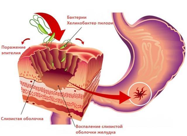 Антибиотики для лечения гастрита