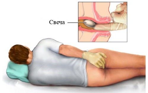 Свечи с облепиховым маслом в гинекологии, проктологии. для чего назначают, свойства. названия, цены