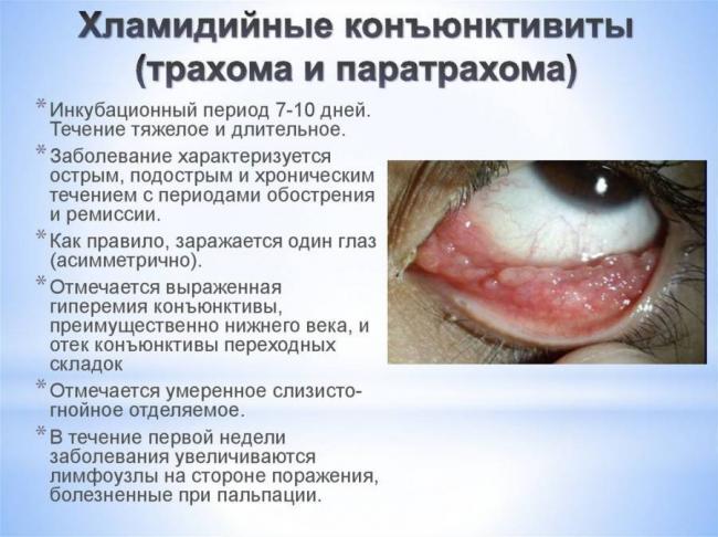 Бактериальный конъюнктивит глаз лечение у взрослых капли