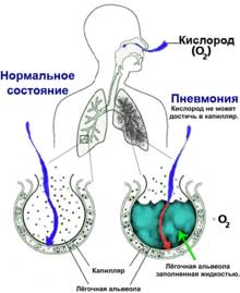 Симптоматика, диагностика и лечение аспирационной пневмонии у новорожденных