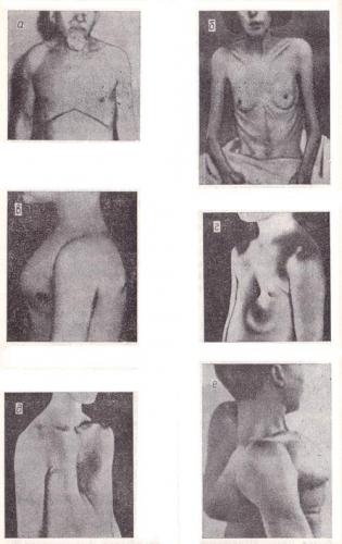 Деформация грудной клетки: причины заболевания, основные симптомы, лечение и профилактика