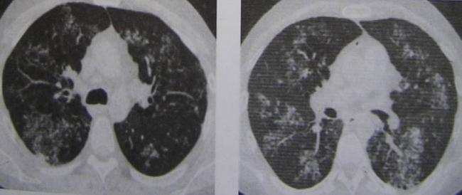 Очаг в лёгком - вопрос пульмонологу - 03 онлайн
