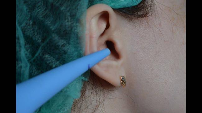 Ушная пробка у ребенка: симптомы, как избавиться и удалить в домашних условиях, как выглядит