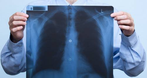 Двусторонняя пневмония у пожилых людей прогноз для жизни