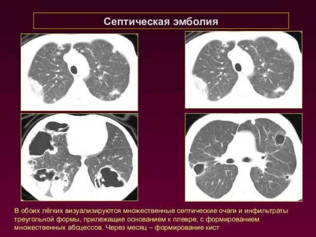 Что обозначают лёгочные очаги на кт