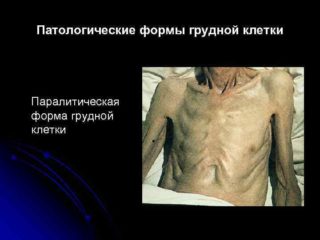 Воронкообразная грудная клетка у ребенка: что делать?