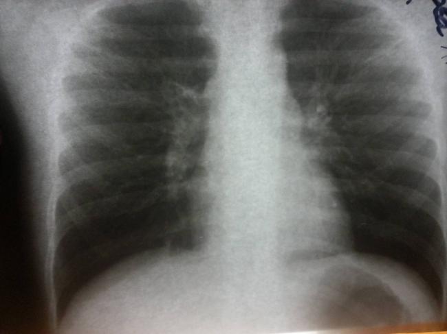 Прикорневая пневмония: что нужно знать?