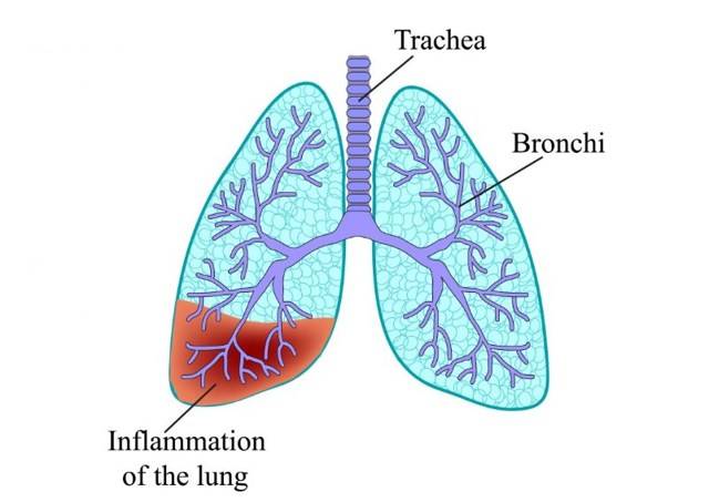 Мокрота с кровью при кашле, причины у взрослых