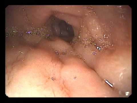 Дуодено гастральный рефлюкс