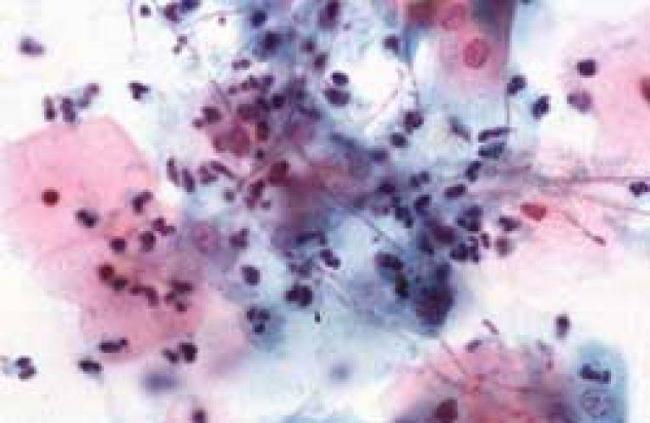 Мазок на флору у женщин. норма, таблица, расшифровка лейкоциты, эритроциты, кокки, при беременности