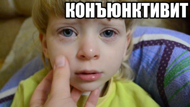 Конъюнктивит глаз: виды заболевания и способы лечения у детей