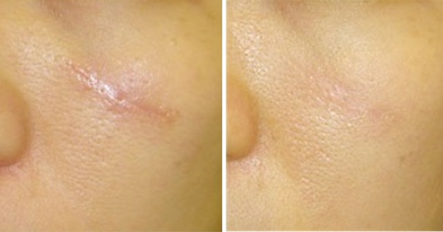 Дерматикс (мазь, гель)