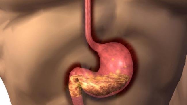 Недостаток кардии желудка лечение народными средствами