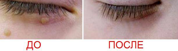 Папиллома на веке удаление народными средствами