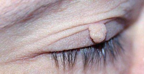 Папиллома на веке удаление народными средствами