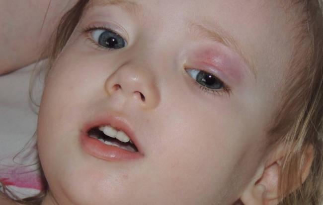 Бактериальный конъюнктивит глаз лечение у взрослых капли