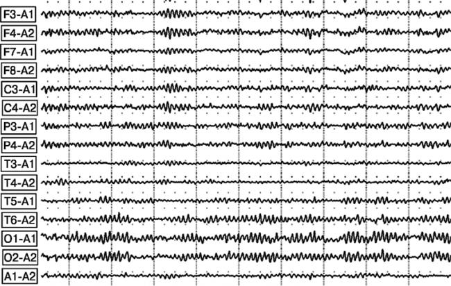 Этиология застойной пневмонии в пожилом возрасте