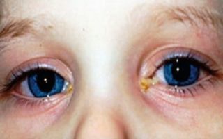 Топ лучших капель для глаз при конъюнктивите у взрослых: обзор