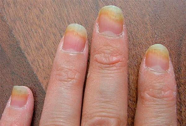 Почему ломаются и слоятся ногти? правила маникюра и народные рецепты