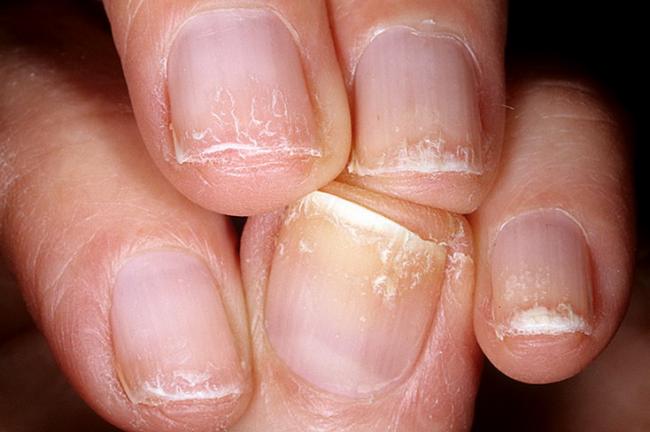 Ломкие ногти на руках: причины, лечение, витамины
