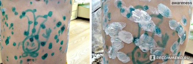 Циндол при ветрянке у детей: показания и инструкция