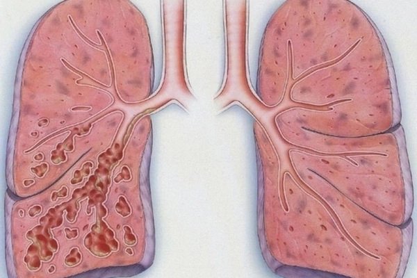 Пневмосклероз: что происходит с легкими, сколько живут при этом заболевании?