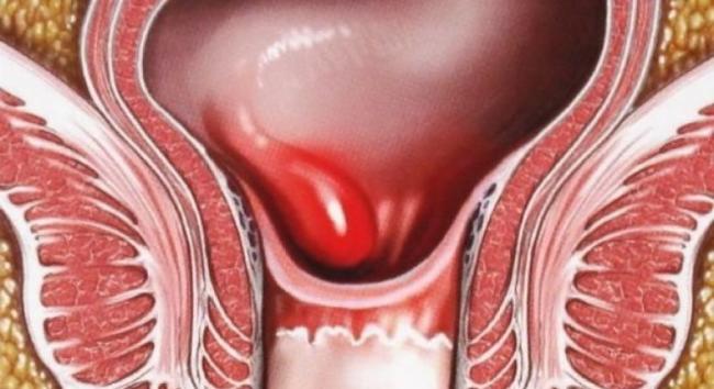 Геморрой – причины возникновения у мужчин и женщин, от чего появляется геморрой после родов?