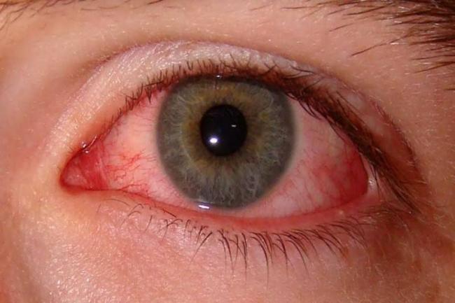 Бактериальный конъюнктивит глаз лечение у взрослых капли