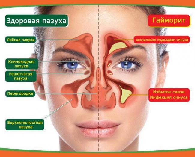 Можно ли вылечить гайморит без антибиотиков и как это сделать