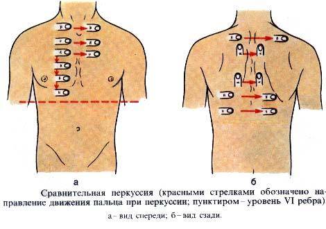 Застойная пневмония у лежачих больных лечение