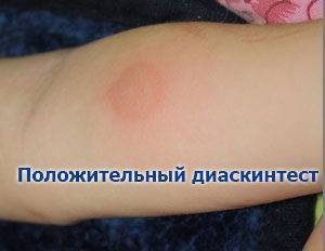 Манту и диаскинтест: что нужно знать родителям