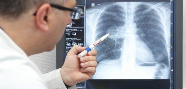 Пневмония сердечная недостаточность симптомы