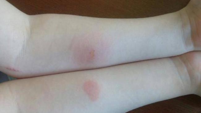 Манту при аллергии у ребенка