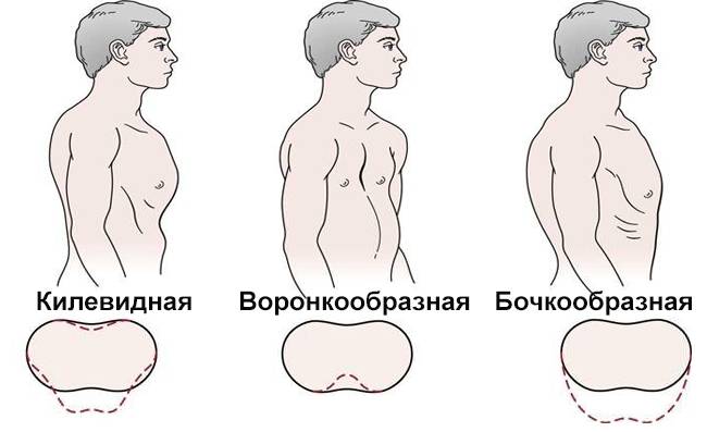 Лечение воронкообразной деформации грудной клетки у детей без операции: лфк, упражнения, массаж