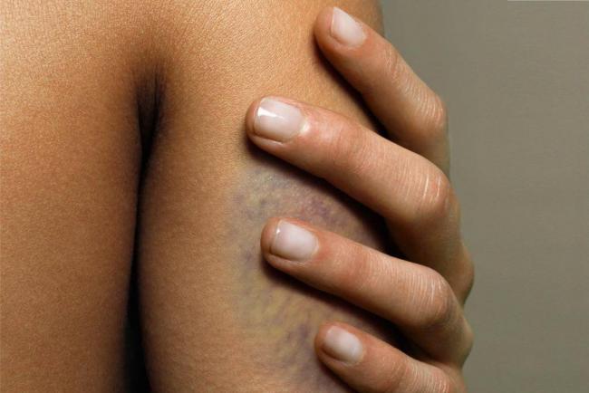 Синяк-офф: гель под глаза, мазь, инструкция по применению