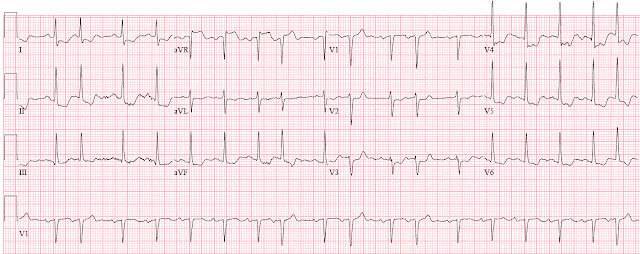 Пневмония на фоне сердечной недостаточности